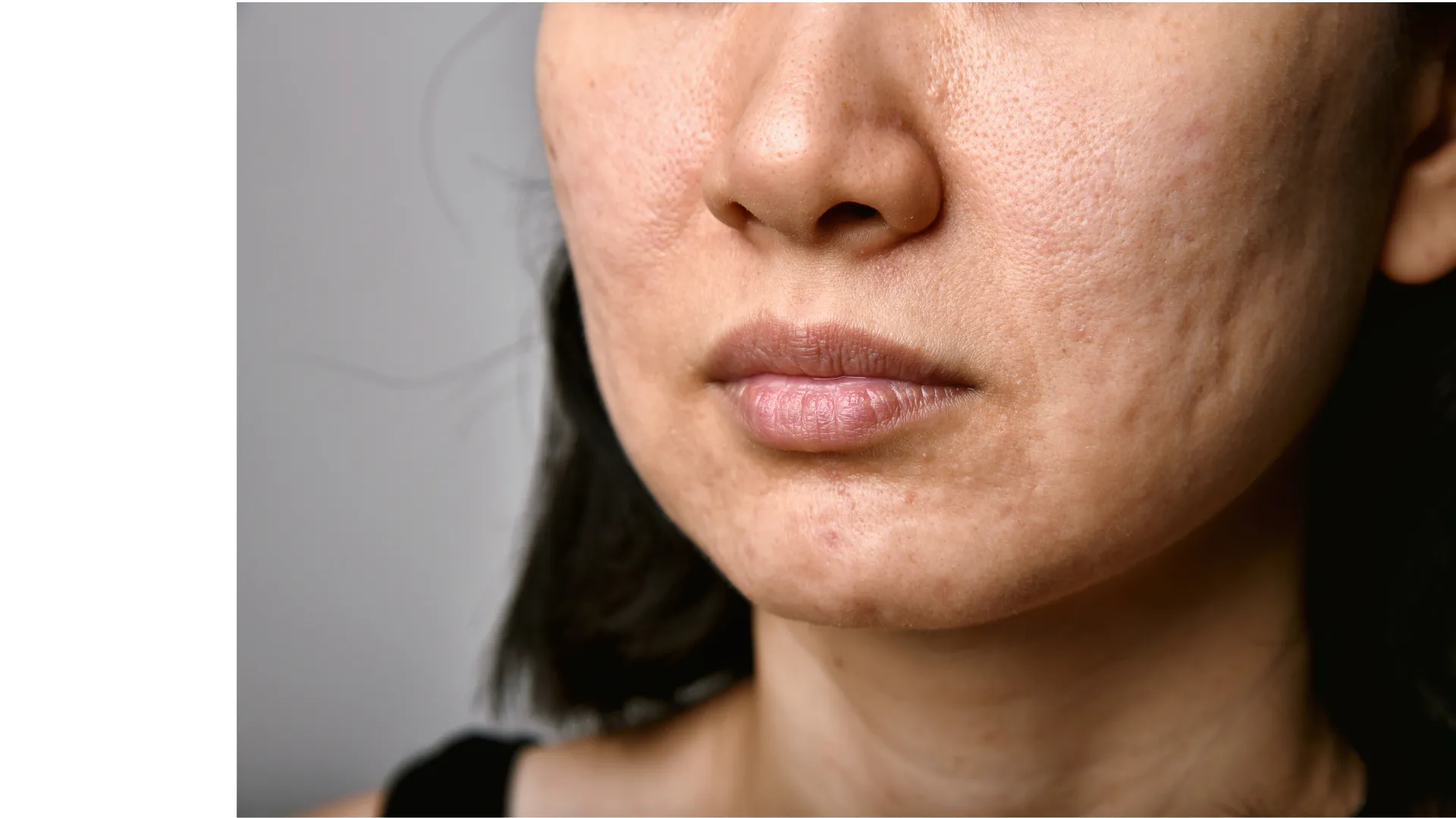 Close-up of a woman's cheek and chin showing acne scars and post-inflammatory dark marks
