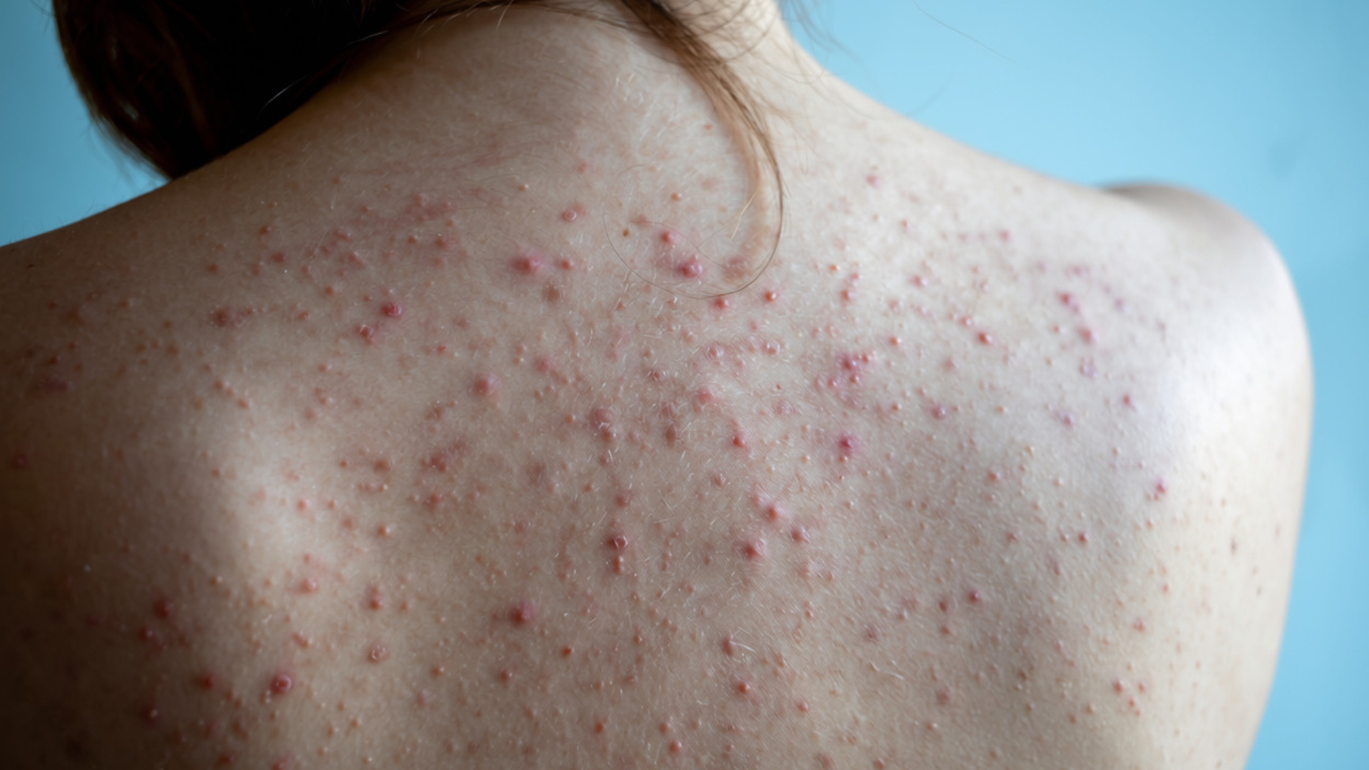 Acne on a person's upper back — back acne (bacne) is common and very treatable