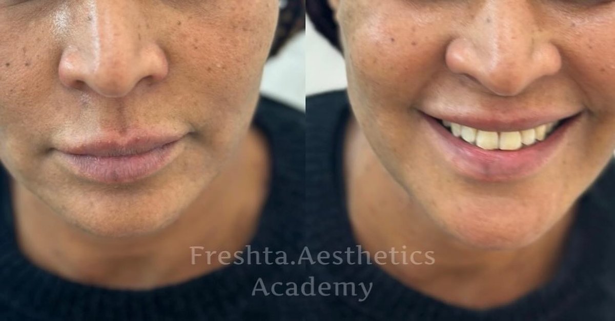 Dermal filler before and after — nasolabial folds softened, consented client photo from our Bury & Manchester clinic