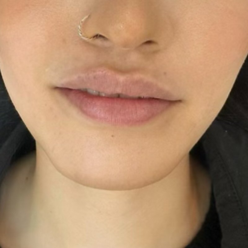 Lips after lip filler treatment — natural volume and definition, consented client photo from our clinic near Manchester