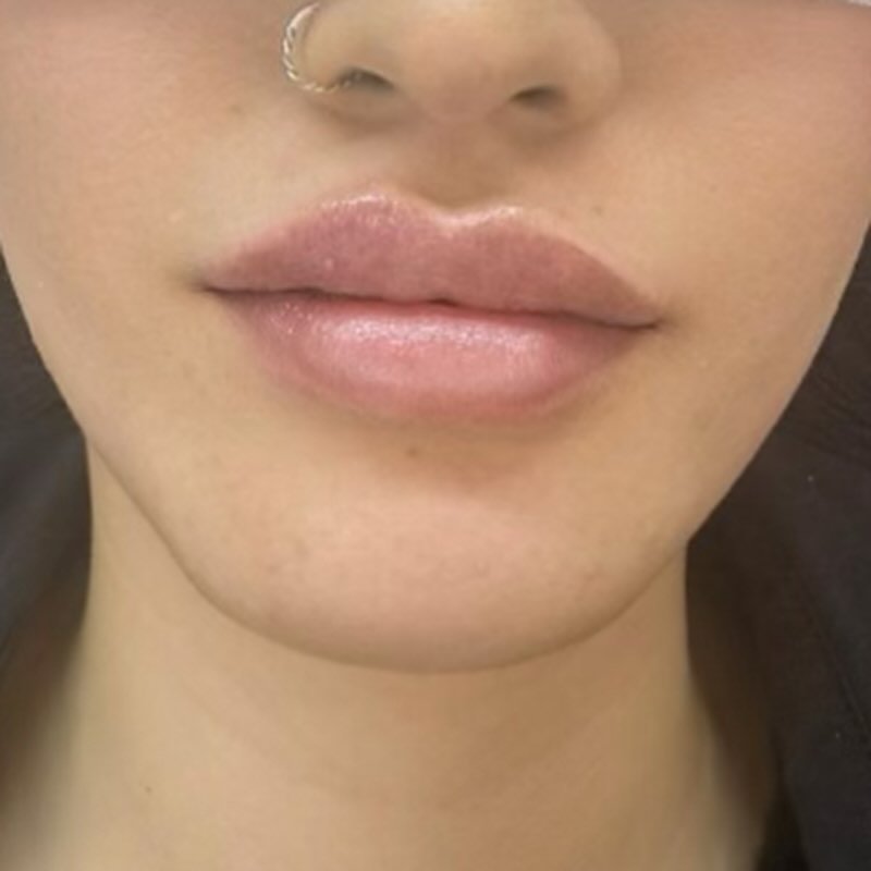 Lips after lip filler treatment — natural volume and definition, consented client photo from our clinic near Manchester
