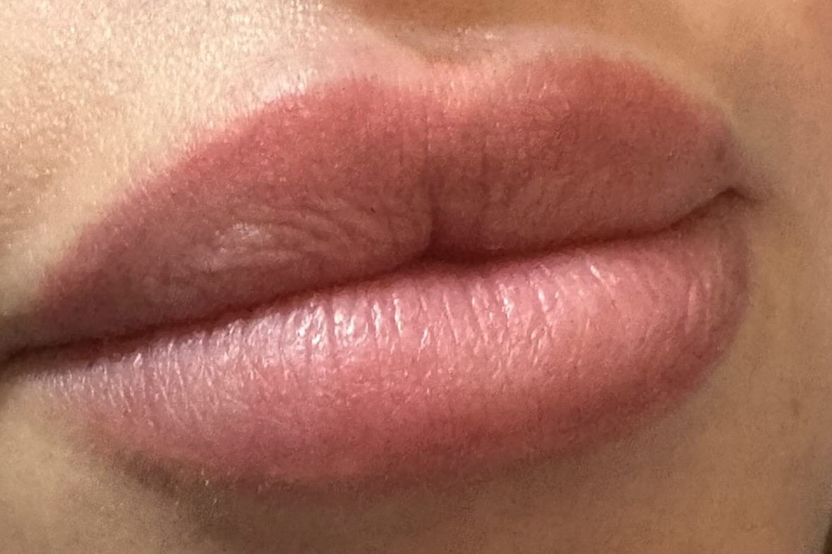 Natural-looking lip filler results from our prescriber-led clinic in Bury, near Manchester