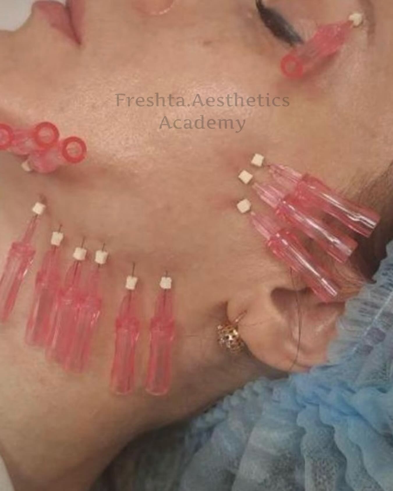 Aesthetic practitioner administering a skin booster treatment at Bury Healthcare Aesthetics in Bury