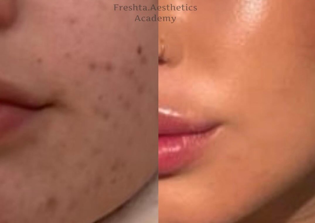 Skin boosters before and after — clearer, more even and hydrated skin at Bury Healthcare Aesthetics